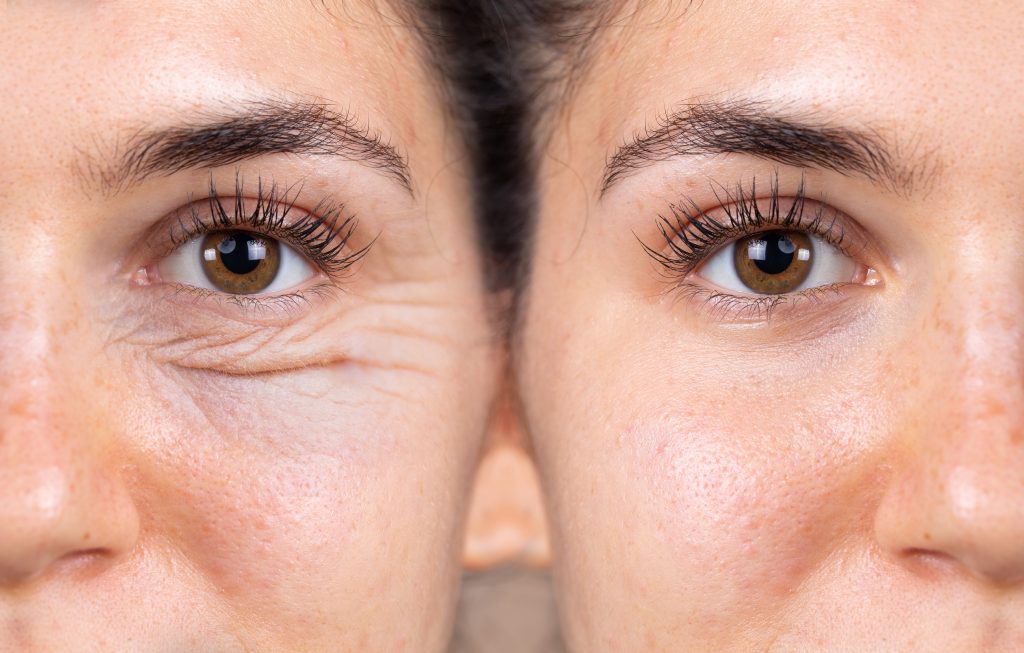 לפני ואחרי ניתוח הסרת שקיות מתחת לעיניים