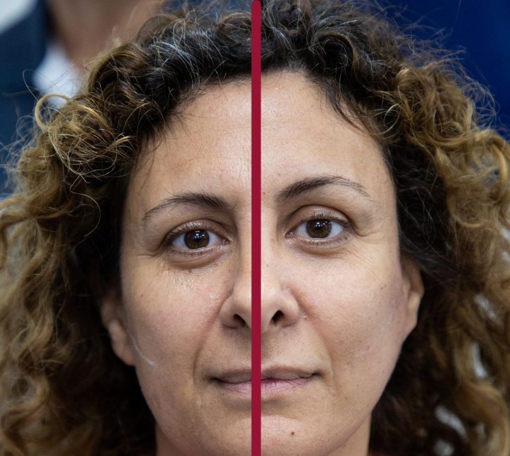 לפני ואחרי הרמת פנים עם חוטים - רשת מרפאות פרופורציה