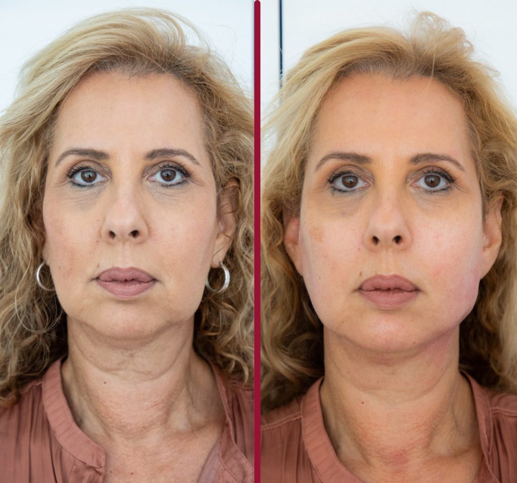 לפני ואחרי הרמת פנים עם חוטים - רשת מרפאות פרופורציה