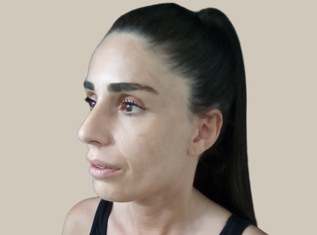 ניתוח אף לפני