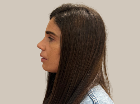 ניתוח אף אחרי