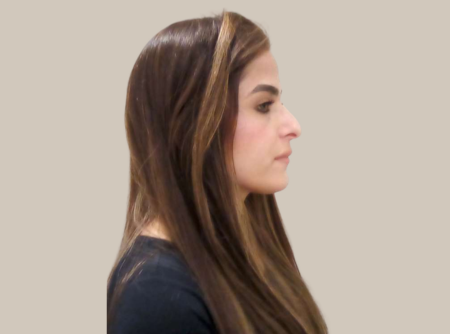 לפני ניתוח אף