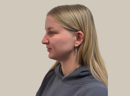 לפני ניתוח אף