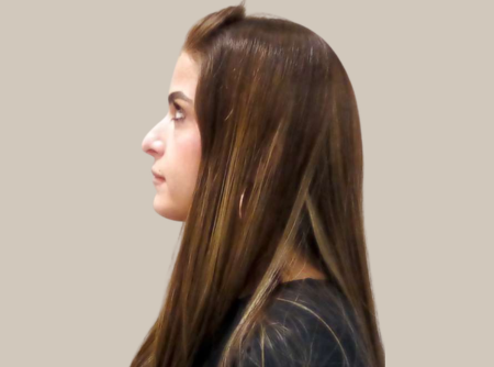 לפני ניתוח אף