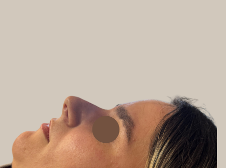 אחרי פיסול אף