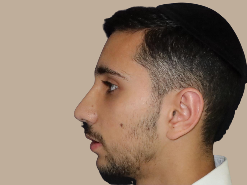 אחרי ניתוח אף