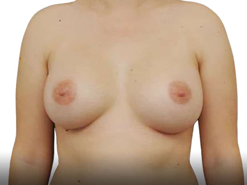 118791-after-breast-augmentation-proportsia