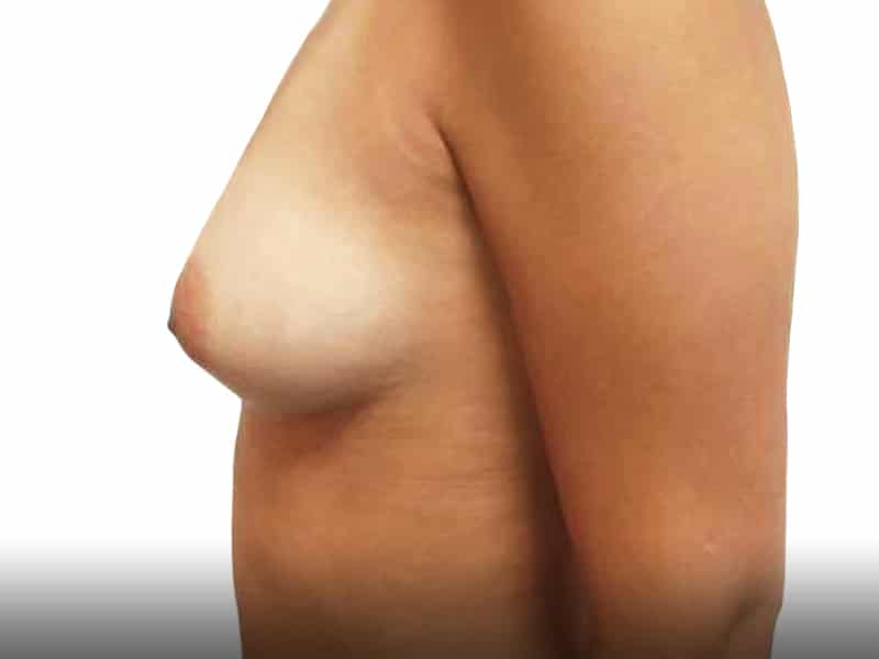 334800-before-breast-augmentation-proportsia