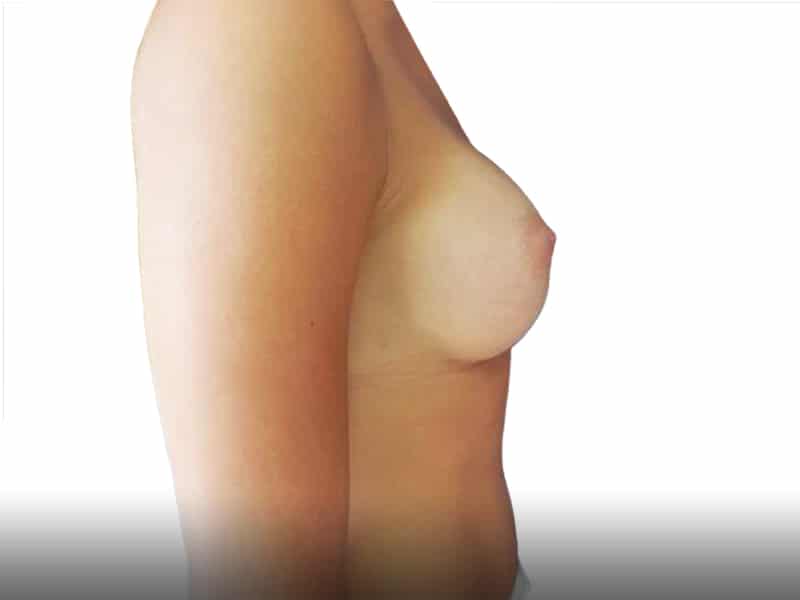 364244after-breast-augmentation-proportsia