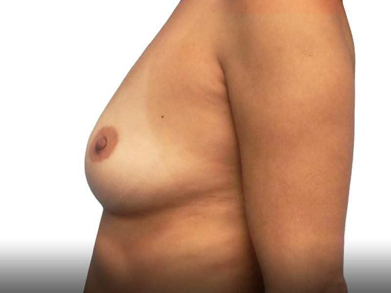 381096-breast-augmentation-before
