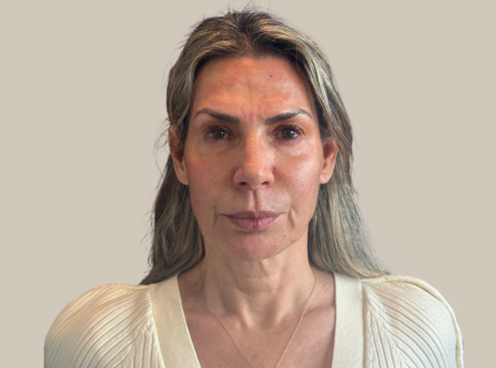 לפני העלמת קמטים