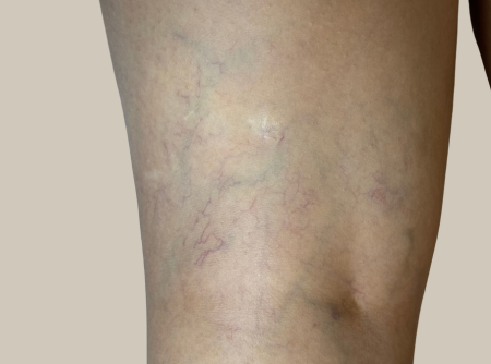 העלמת נימים אחרי