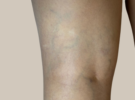 העלמת נימים לפני