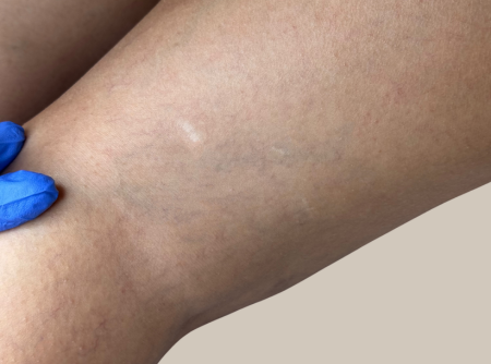 העלמת נימים אחרי