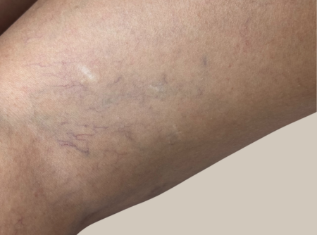 העלמת נימים לפני