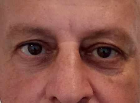 ניתוח הרמת עפעפיים לפני