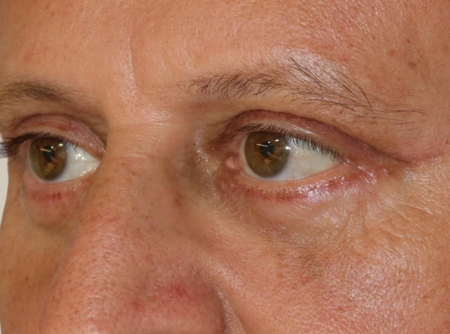 ניתוח הרמת עפעפיים אחרי