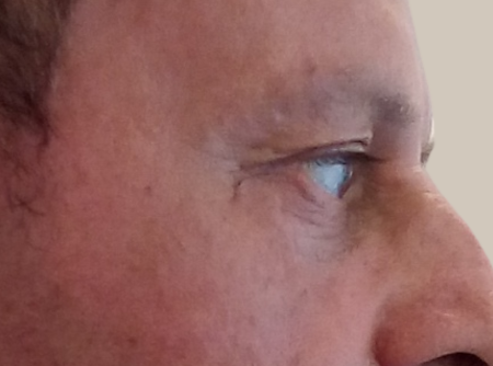 ניתוח הרמת עפעפיים לפני