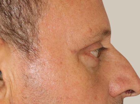 ניתוח הרמת עפעפיים אחרי