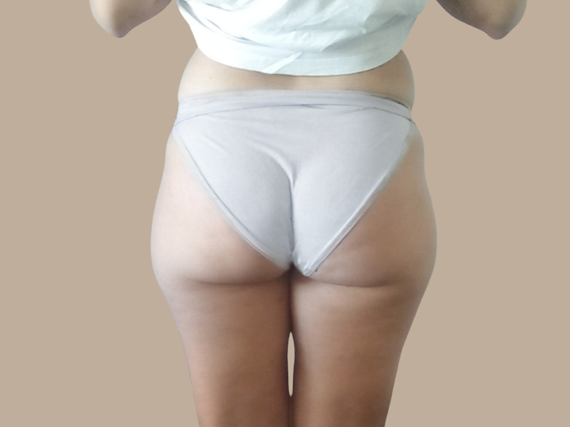 הקפאת שומן לפני