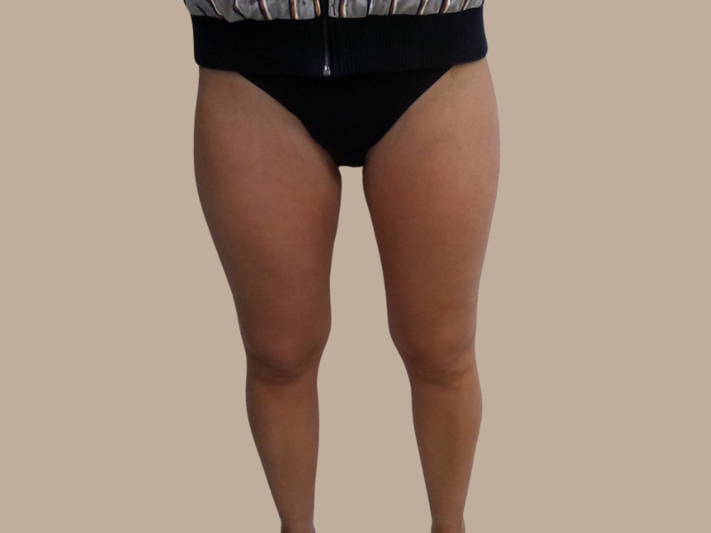 הקפאת שומן אחרי