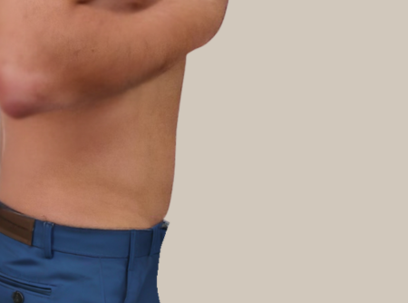 הקפאת שומן אחרי