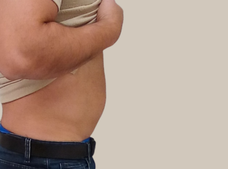 הקפאת שומן לפני