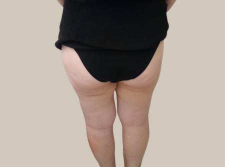 הקפאת שומן אחרי