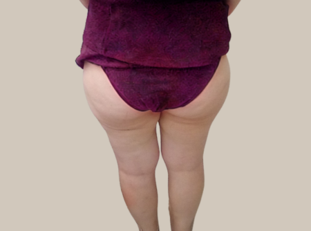 הקפאת שומן לפני