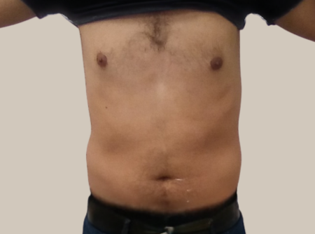 הקפאת שומן לפני