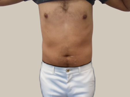 הקפאת שומן אחרי