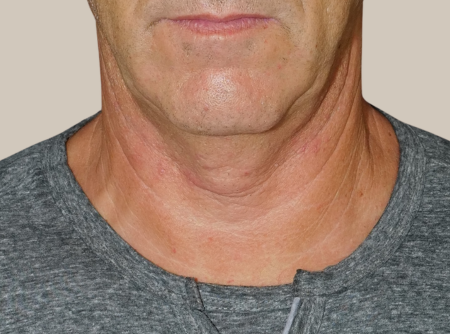 ניתוח מתיחת צוואר לפני