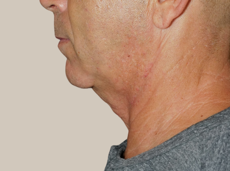 ניתוח מתיחת צוואר לפני