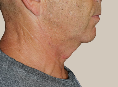 ניתוח מתיחת צוואר לפני