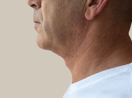 ניתוח מתיחת צוואר אחרי