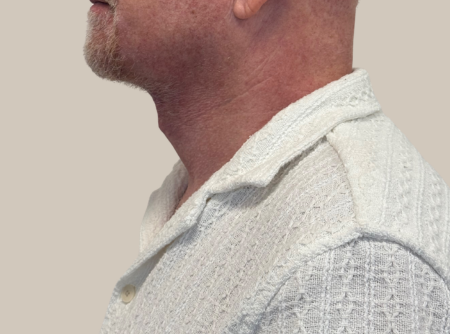 אחרי ניתוח מתיחת צוואר