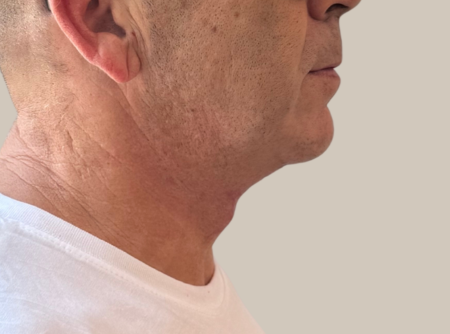 ניתוח מתיחת צוואר אחרי