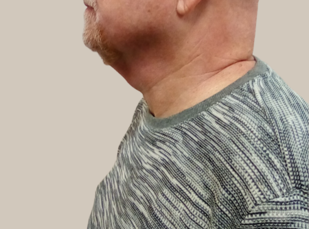 לפני ניתוח מתיחת צוואר