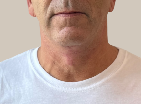 ניתוח מתיחת צוואר אחרי